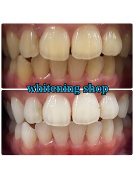 ホワイトニングショップ 長崎店/ビフォーアフター