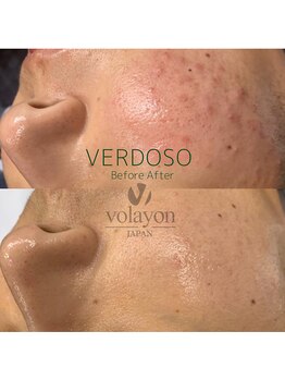 ジュエッテ(jouete)/volayon