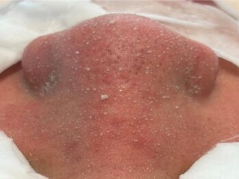 モーヴ 藤沢(MAUVE)の写真/【SNSで超話題!】韓国式3D毛穴洗浄が藤沢で受けられる!!驚く程に浮き出る毛穴汚れで頑固な黒ずみ徹底除去！