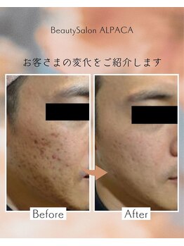 アルパカ(ALPACA)/ブツブツや跡のお悩み
