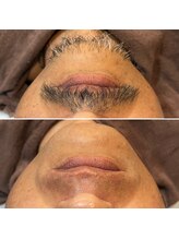 トリプルワン(111)/ヒゲWAX脱毛