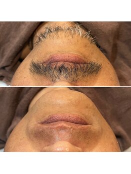 トリプルワン(111)/ヒゲWAX脱毛