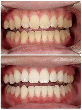 ホノルルホワイトニング 京橋店/12回券 ホワイトニング症例写真