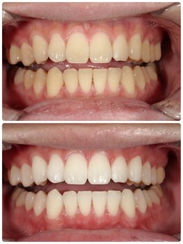 ホノルルホワイトニング 京橋店/12回券 ホワイトニング症例写真