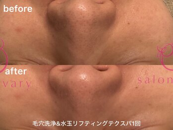 ヴェアリー 広尾(VARY)/毛穴洗浄