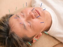 イロドリ 南森町(irodori)/美容鍼