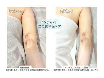 カリド ラボ(CALIDO LAB)/術後ケア　二の腕（首デコルテ）