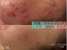 サロンヴェアリー 広尾(salon vary)/水玉+ハーブピーリング