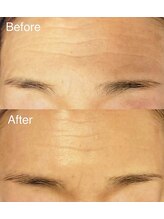 ブランシェ 金沢店 × 椿/シワ・たるみケア『60代お客様』