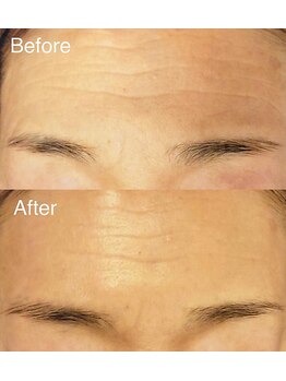 ブランシェ 金沢店 × 椿/シワ・たるみケア『60代お客様』