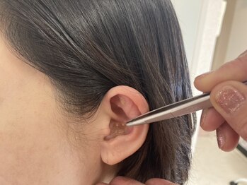 アンビジュー(un bijou)の写真/【痩身】3か月二人三脚でサポート!別人のような自分に出会うために、今から耳つぼダイエット始めましょう♪