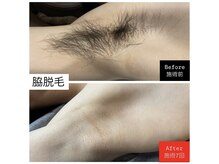 ヴァリエ(Varier)/BeforeAfter