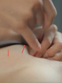 アリエス整骨院 恵比寿/恵比寿で鍼灸