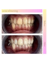 エクシアホワイトニング 札幌中島公園店/BeforeAfter［ホワイトニング］ 