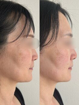 ルアンビューティー メディカルプラス(Luan beauty MEDICAL+)/チタニウムリフト×1回