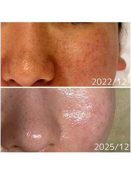 メープルサロン(MAPLE SALON)/毛穴リセットコース