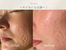 【凹凸ニキビを徹底改善！】毛穴リペア＆美肌改善フェイシャルでつるん肌へ