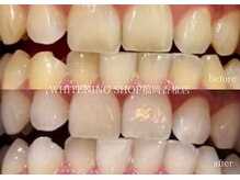ホワイトニングショップ 福岡香椎店/美容ホワイトニングbefore after