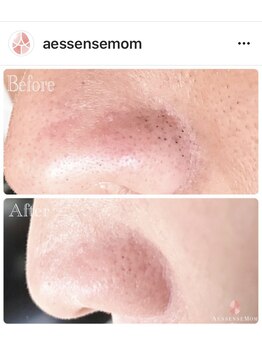 エッセンスマム 東京 プレナタールサロン(Prenatal salon)/黒ずみが綺麗になり驚かれます