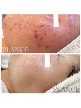 プランス 渋谷(PLANCE)/毛穴/ハーブピーリング