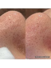 ルナート(Lunart)/毛穴洗浄／毛穴ケア