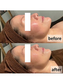 セイリキ(SEIRIKI)/光フェイシャル