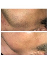 バルダー 原宿 神宮前(BALDER.)/メンズ（髭）脱毛