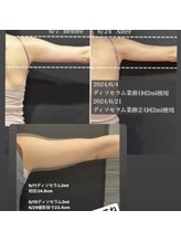 レ ベージュ(L’Beige)/美容溶解◆脂肪をすっきり小さく