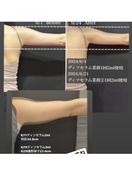 レ ベージュ(L’Beige)/美容溶解◆脂肪をすっきり小さく