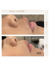 モアトゥインクル 山口店(MORE twinkle)/★症例写真★【小学生】