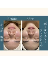 エステ大阪PON/赤ら顔改善