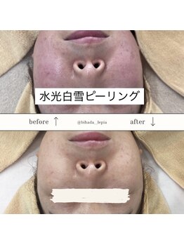 レピア(Le'pia)/水光白雪ピーリング