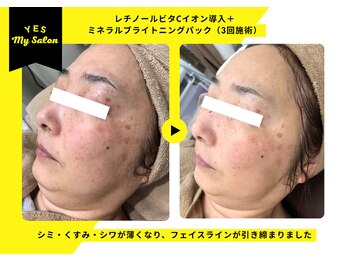 イエス マイサロン(yes My Salon)/ENVIRONトリートメント症例