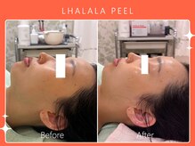 ハノハノ 八代店(HANO HANO)/韓国肌管理ララピール☆