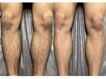 シルビー(CILBE)/足ミックス脱毛