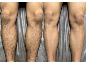 シルビー(CILBE)/足ミックス脱毛