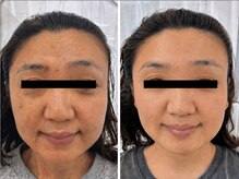 整顔院 学芸大学店/４０代　継続期間６ヶ月