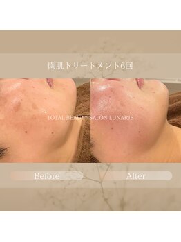 ルナージュ(LUNARJE)/陶肌トリートメント