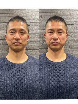 長寿鍼灸院 長寿整骨院/men's男性専用25本美容鍼★