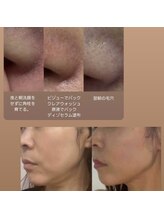 レ ベージュ(L’Beige)/美容溶解◆脂肪をすっきり小さく