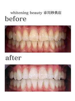 ホワイトニングビューティー 市川妙典店/歯科提携/ホワイトニング/妙典