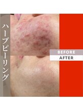 エンジェル(Angel)/ハーブピーリングで肌質改善！