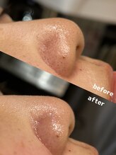 ラエッセ 恵比寿(LAESSE)/【毛穴詰まり・黒ずみ改善】