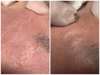 サラグランデ(Sara Grande)/眉間、眉上も沢山取れます!