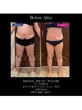 ドルチェビューティーサロン 戸塚安行店(Dolce Beauty Salon)/痩身（お腹・背中_施術15回