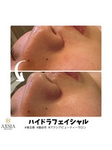 アクシア ビューティー サロン(AXSIA)/【ハイドラ】BeforeAfter