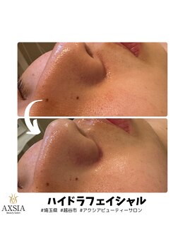 アクシア ビューティー サロン(AXSIA)/【ハイドラ】BeforeAfter