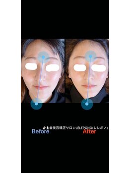 美容矯正サロン レレポノ(LELEPONO)/鼻の歪み、輪郭、口角、小顔施術