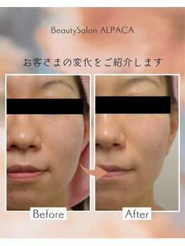 アルパカ(ALPACA)/毛穴・小顔のお悩み