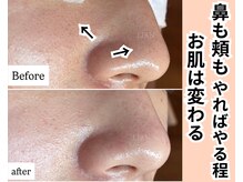 リアン(LIAN)/毛穴改善プレミアムコース